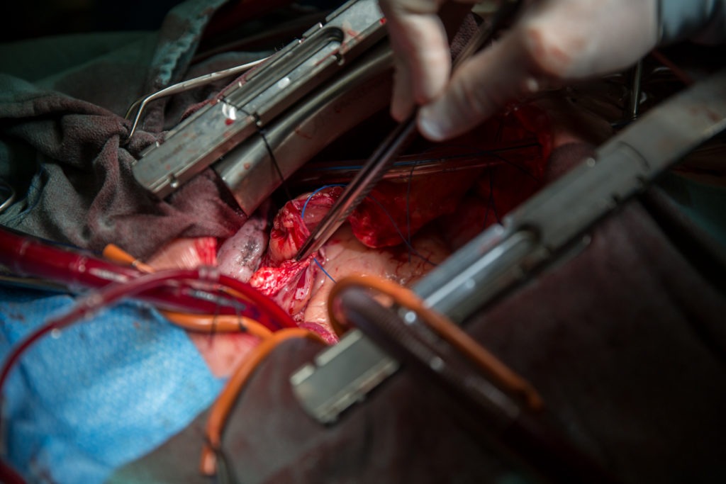 Dr. Whitlock looks inside the patient’s lung cavity for an artery to be used in the bypass graft. In CABG procedures, vessels are harvested from either the patient’s own leg, lung area or both.