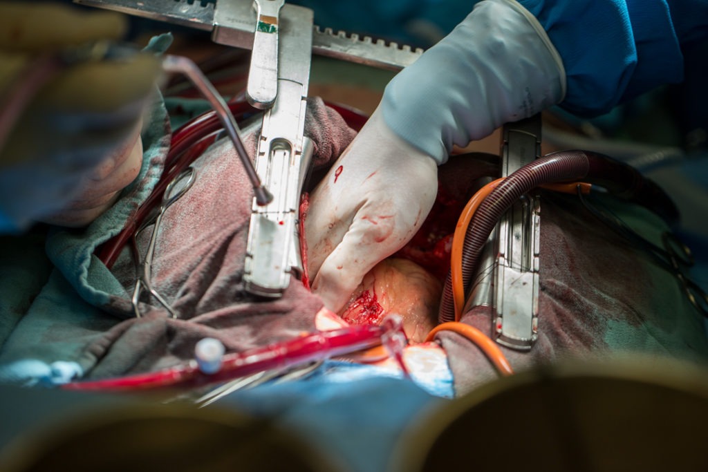 The patient’s chest is held open by a sternal retractor while Dr. Whitlock lifts the heart to take a closer look at the surrounding blood vessels.