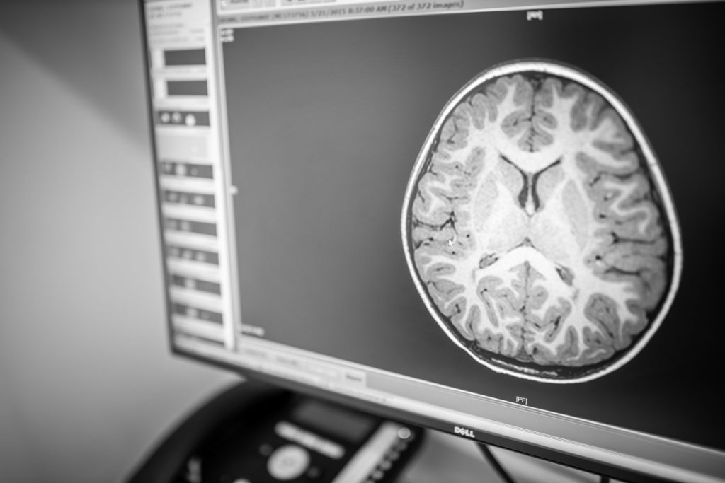 brain scan on computer screen