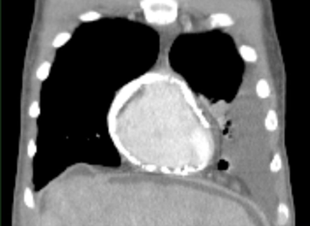 a CT scan showing the case of calcium around Herve's heart
