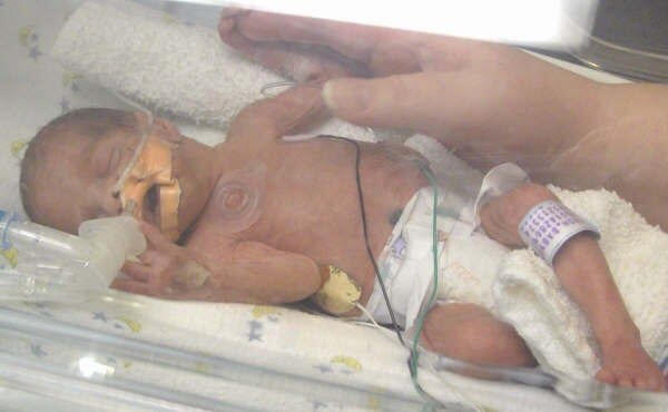 Ciaran in an incubator, just a bit bigger than his mom's hand