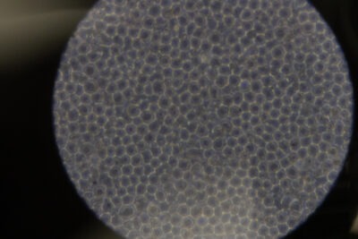 AML cells under the microscope. 